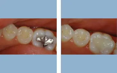 Before and After